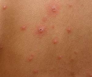 Chickenpox Chickenpox