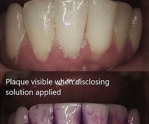 Is It Bad If My Gums Bleed When I Floss?