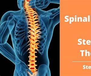 Stem Cells for Spinal Stenosis Stem Cells for Spinal Stenosis